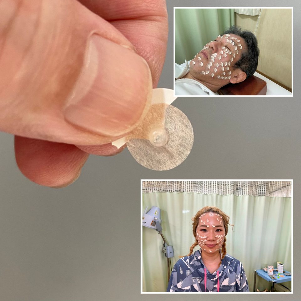 美容鍼＆施術の複合