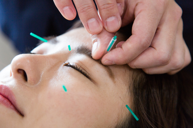 ベーシック美容鍼